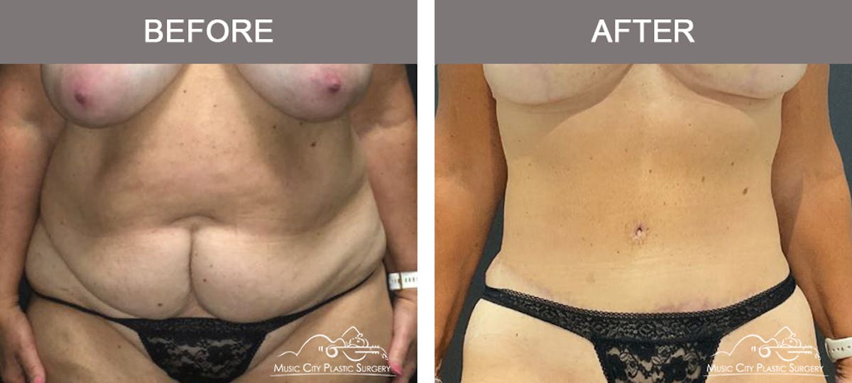 Abdominoplasty Before & After Gallery - Patient 282324 - Image 1