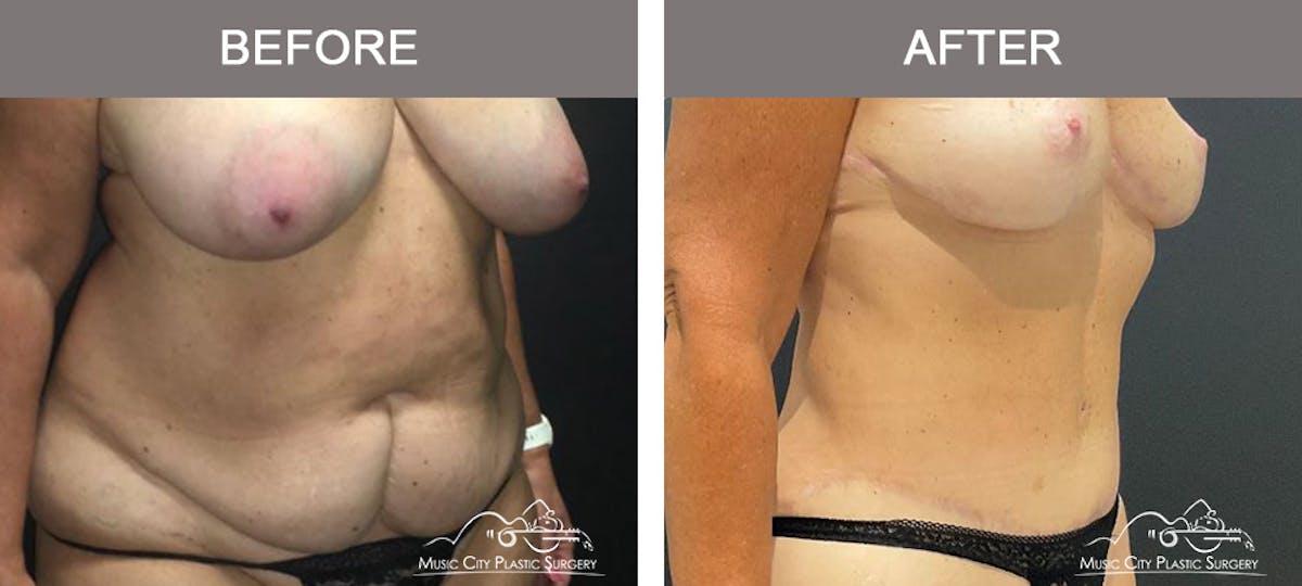 Abdominoplasty Before & After Gallery - Patient 282324 - Image 2