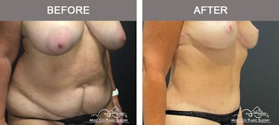 Liposuction Before & After Gallery - Patient 373727 - Image 2
