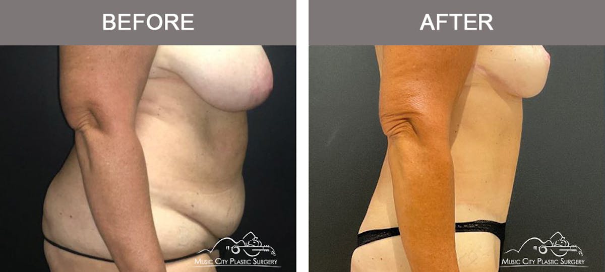 Liposuction Before & After Gallery - Patient 373727 - Image 3