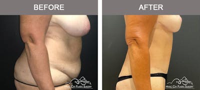 Abdominoplasty Before & After Gallery - Patient 282324 - Image 3