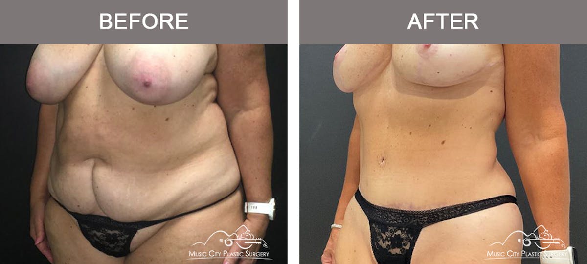 Liposuction Before & After Gallery - Patient 373727 - Image 4