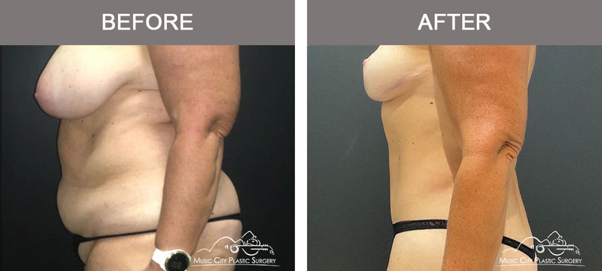 Abdominoplasty Before & After Gallery - Patient 282324 - Image 5