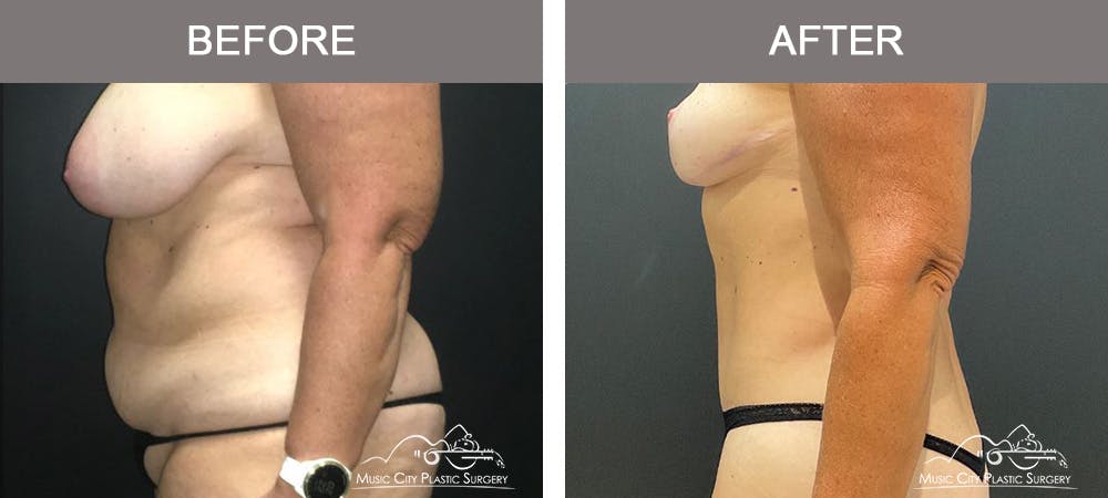 Liposuction Before & After Gallery - Patient 373727 - Image 5