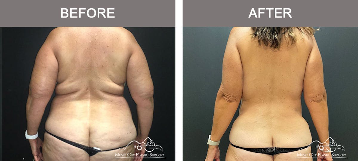Abdominoplasty Before & After Gallery - Patient 282324 - Image 6