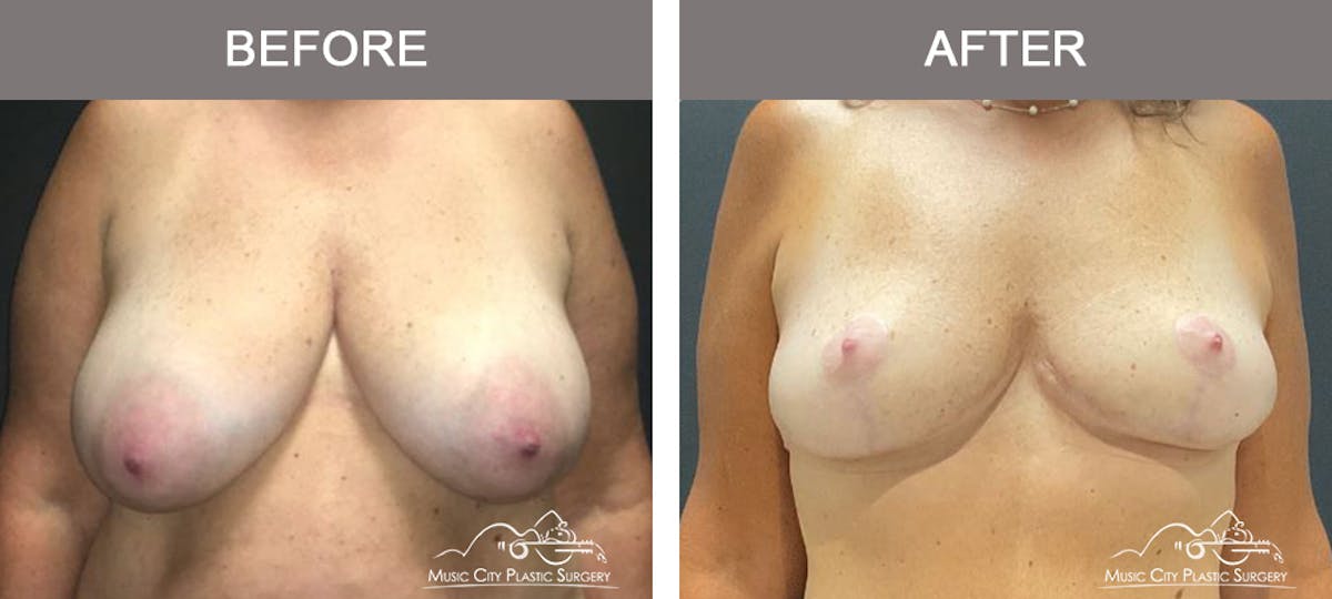 Breast Reduction Before & After Gallery - Patient 175500 - Image 1
