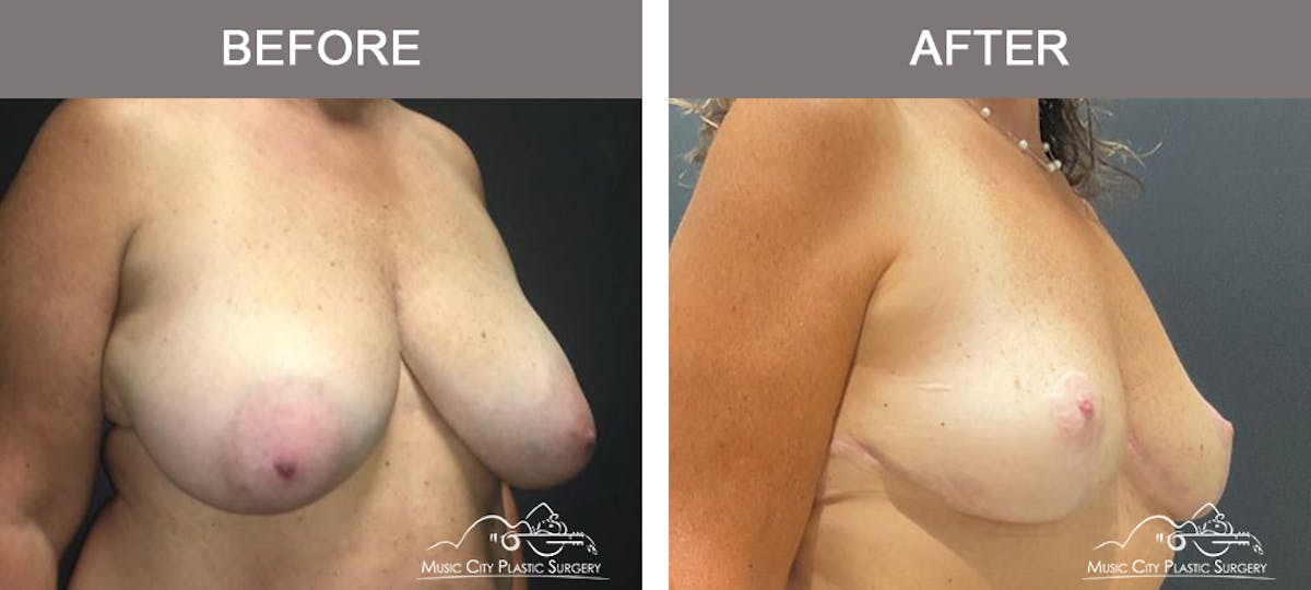 Breast Reduction with Lift Before & After Gallery - Patient 103074 - Image 2