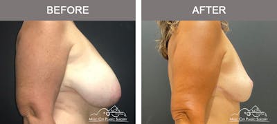 Breast Reduction with Lift Before & After Gallery - Patient 103074 - Image 3