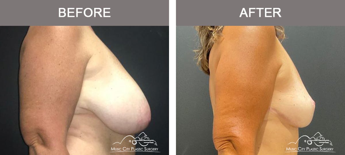 Breast Reduction with Lift Before & After Gallery - Patient 103074 - Image 3