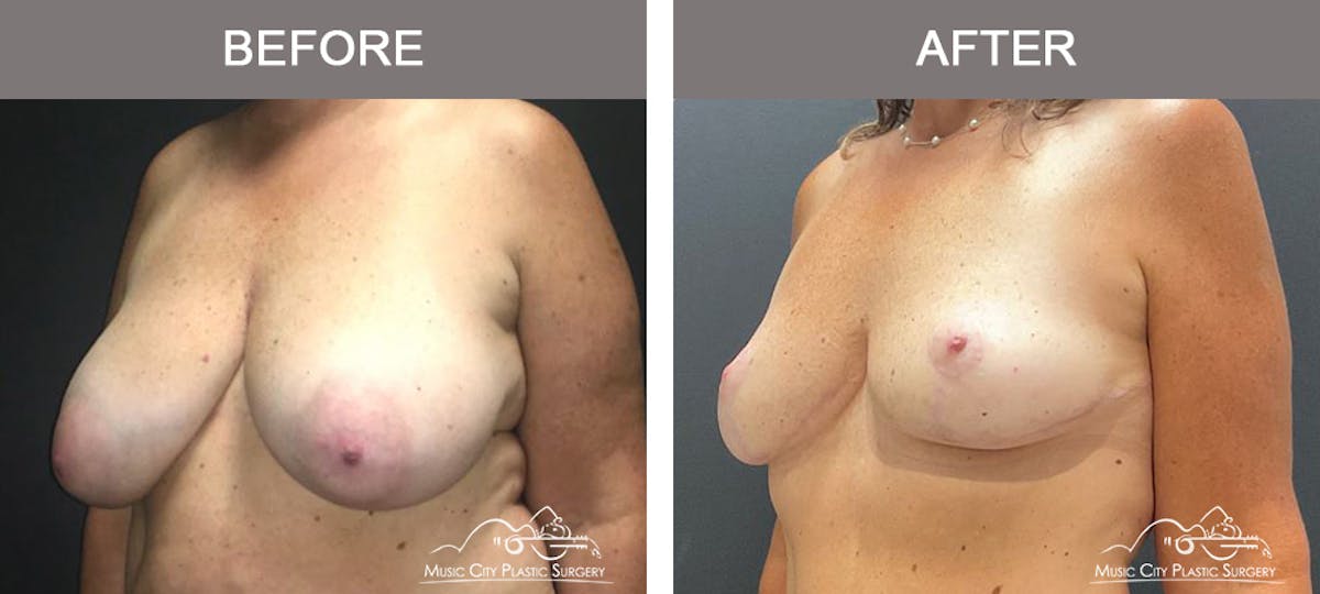 Breast Lift Before & After Gallery - Patient 304038 - Image 4