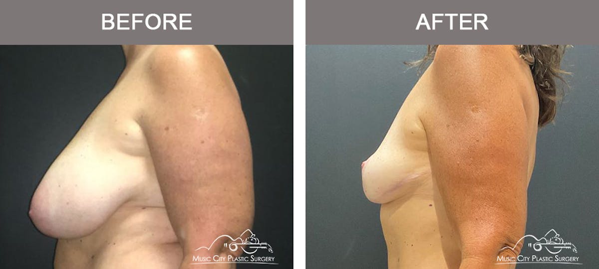 Breast Reduction Before & After Gallery - Patient 175500 - Image 5