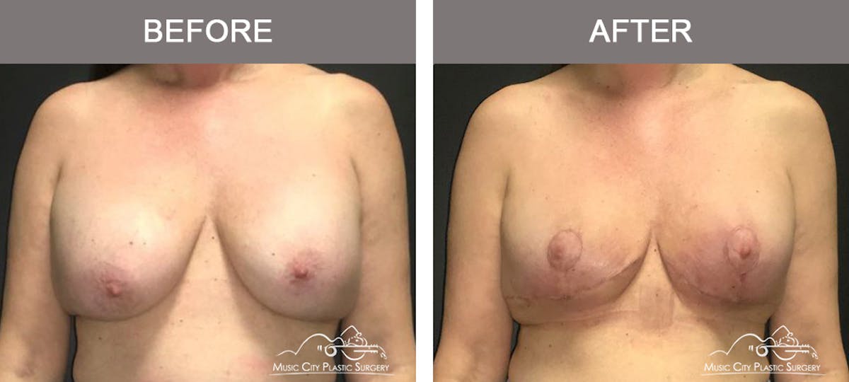Breast Lift Before & After Gallery - Patient 387385 - Image 1