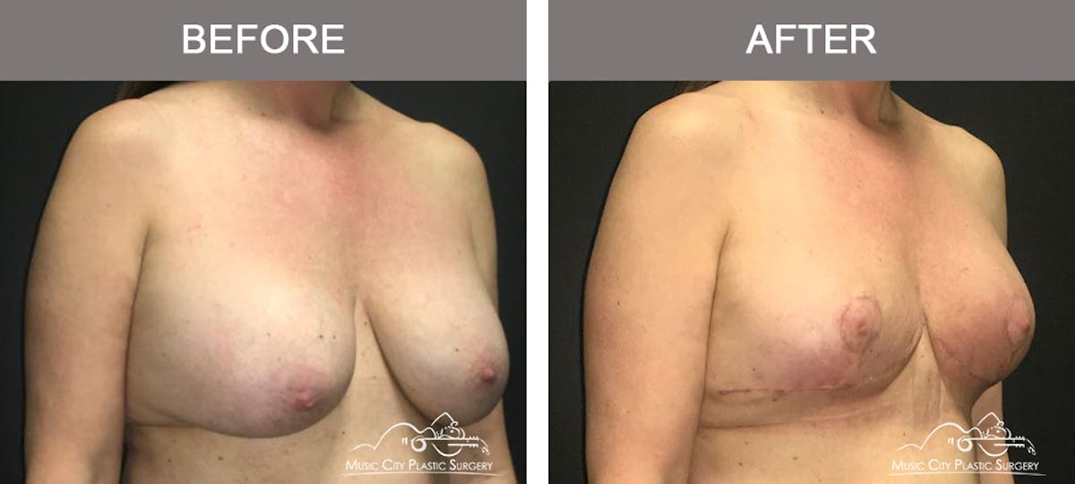 Breast Lift Before & After Gallery - Patient 387385 - Image 2