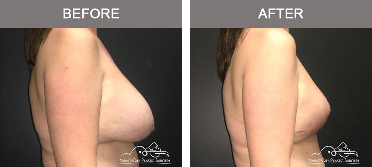 Breast Lift Before & After Gallery - Patient 387385 - Image 3