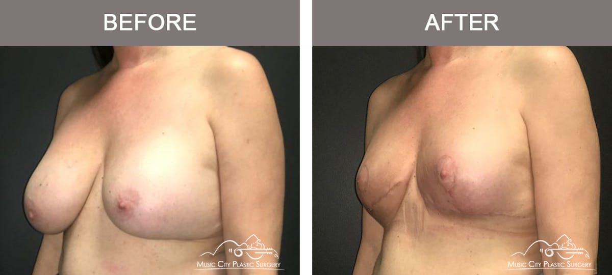 Breast Lift Before & After Gallery - Patient 387385 - Image 4
