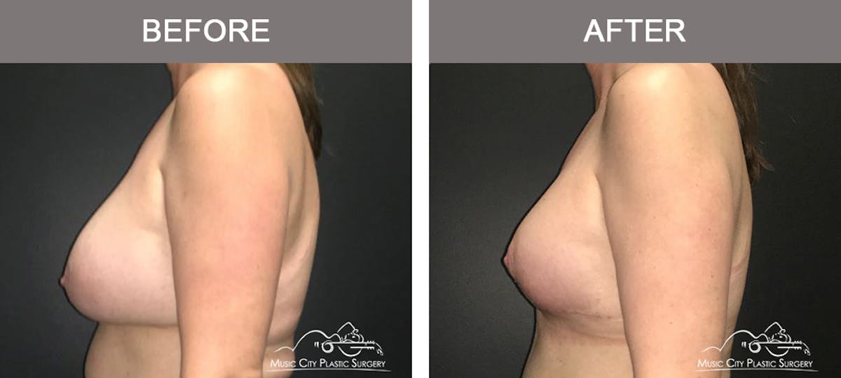 Breast Lift Before & After Gallery - Patient 387385 - Image 5