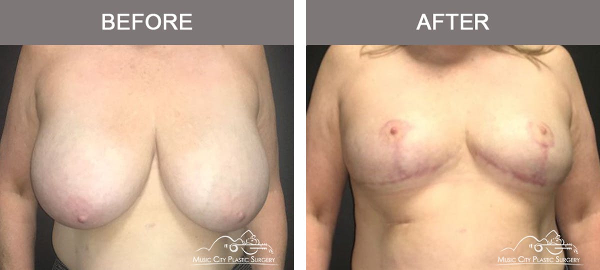 Breast Reduction with Lift Before & After Gallery - Patient 410132 - Image 1