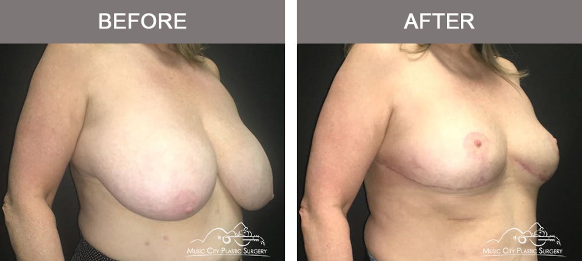 Breast Lift Before & After Gallery - Patient 421840 - Image 2