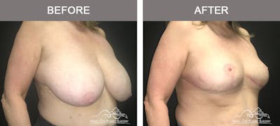 Breast Reduction with Lift Before & After Gallery - Patient 410132 - Image 2