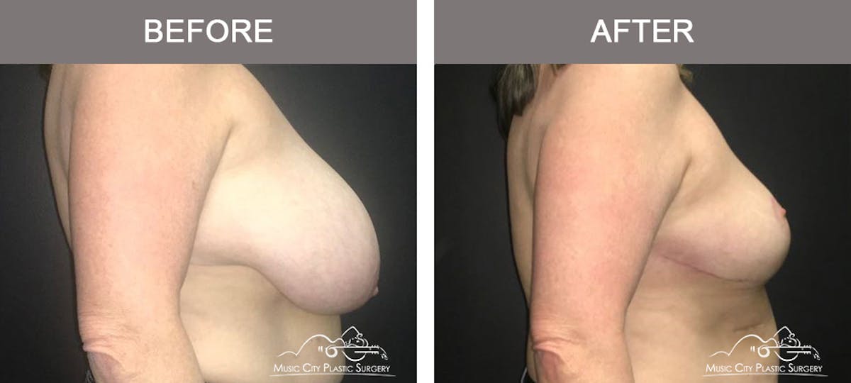 Breast Reduction Before & After Gallery - Patient 949991 - Image 3