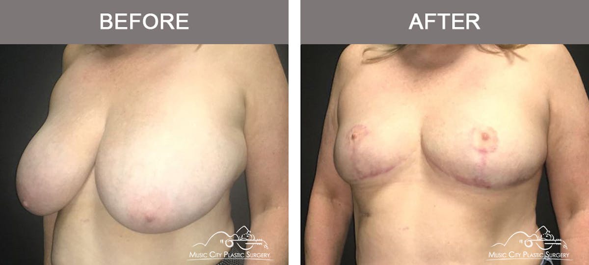Breast Reduction Before & After Gallery - Patient 949991 - Image 4