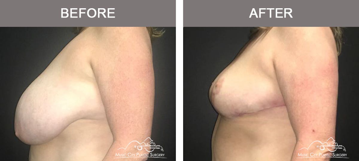 Breast Lift Before & After Gallery - Patient 421840 - Image 5