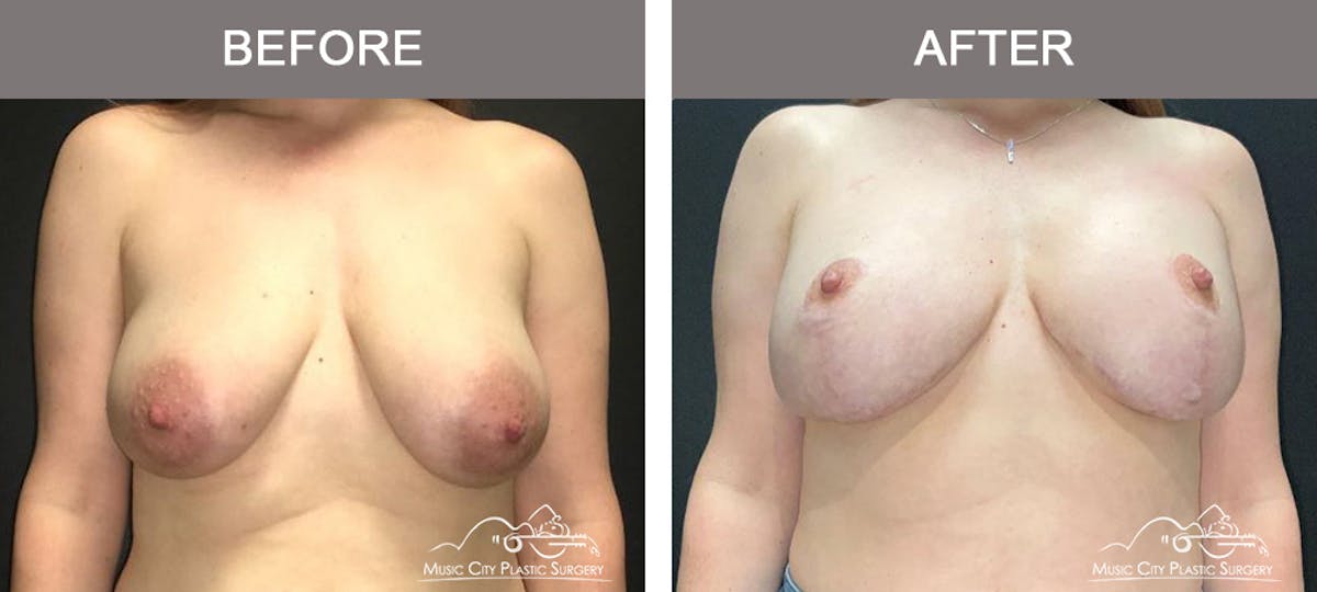 Breast Lift Before & After Gallery - Patient 764304 - Image 1