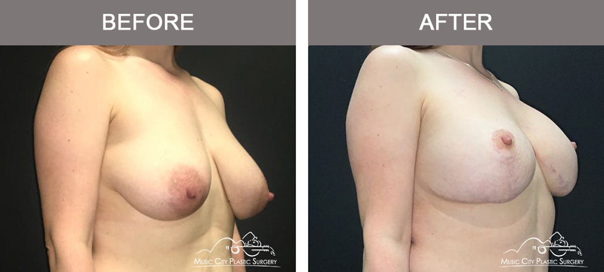 Breast Lift with Augmentation Before & After Gallery - Patient 179247 - Image 2