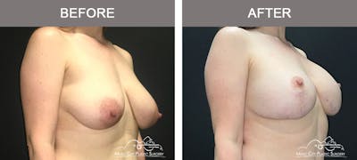 Breast Lift with Augmentation Before & After Gallery - Patient 179247 - Image 2