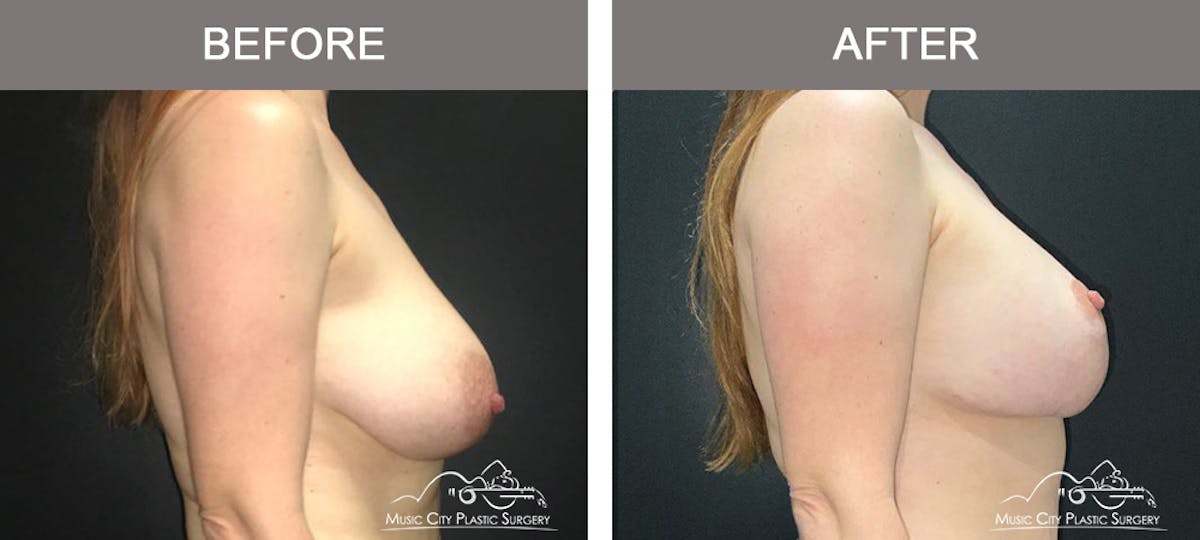 Breast Lift with Augmentation Before & After Gallery - Patient 179247 - Image 3