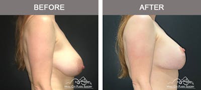 Breast Lift with Augmentation Before & After Gallery - Patient 179247 - Image 3