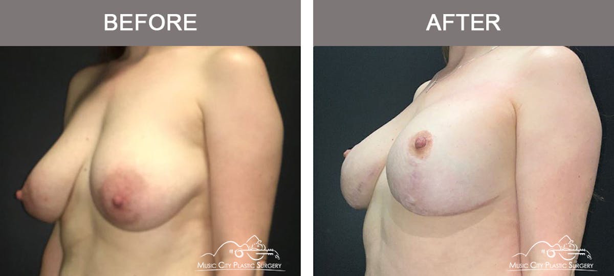 Breast Augmentation Before & After Gallery - Patient 497729 - Image 4