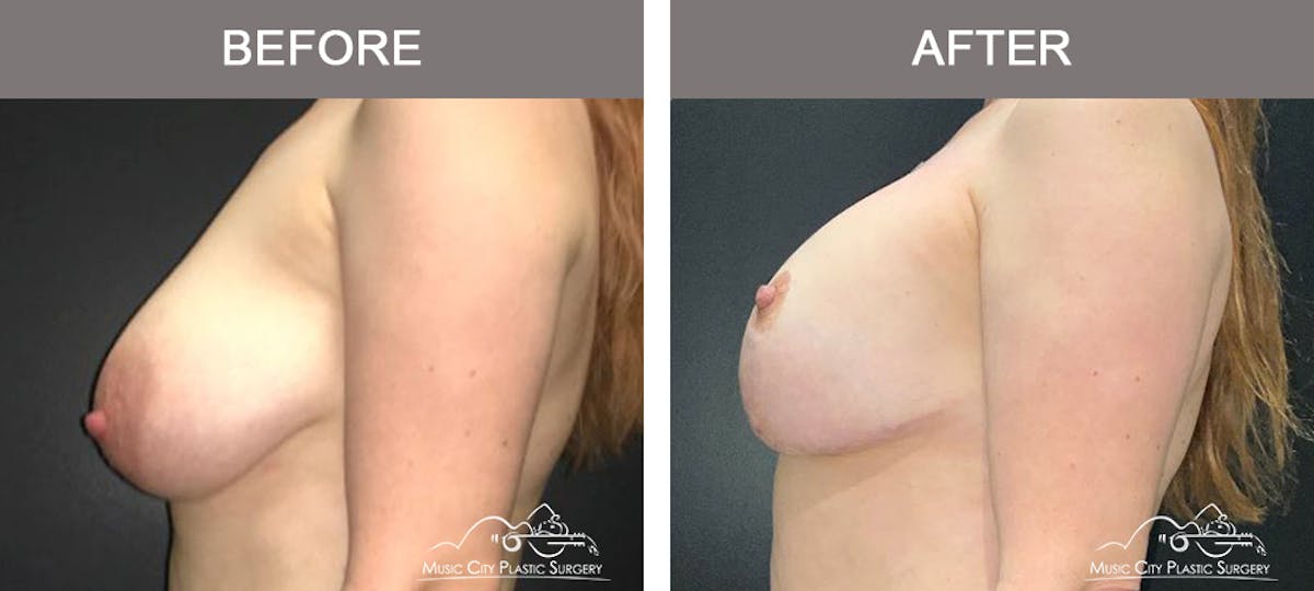 Breast Lift Before & After Gallery - Patient 764304 - Image 5