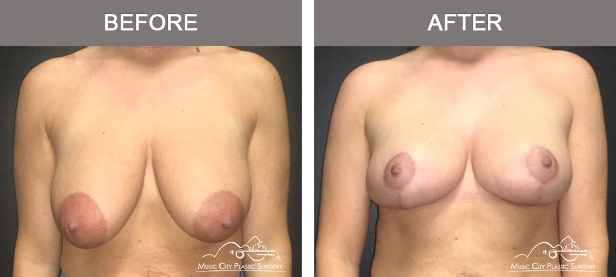 Breast Lift Before & After Gallery - Patient 413661 - Image 1