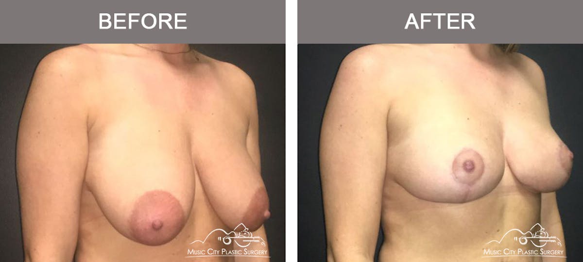 Breast Lift Before & After Gallery - Patient 413661 - Image 2