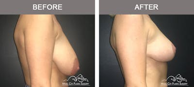 Breast Lift Before & After Gallery - Patient 413661 - Image 3