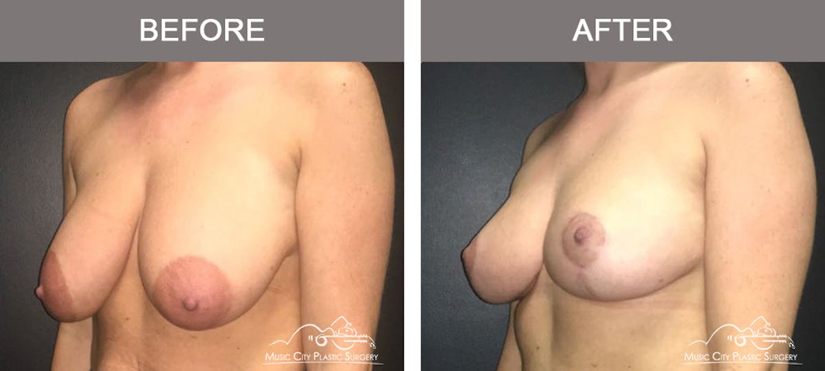 Breast Reduction Before & After Gallery - Patient 313408 - Image 4