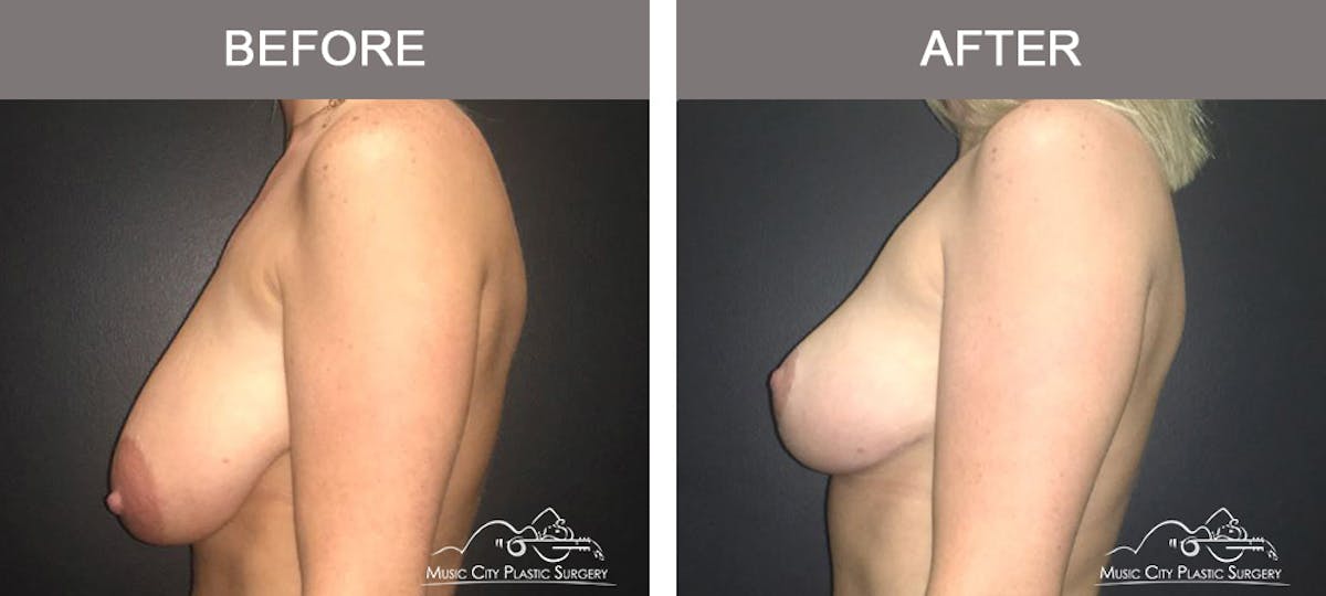 Breast Lift Before & After Gallery - Patient 413661 - Image 5