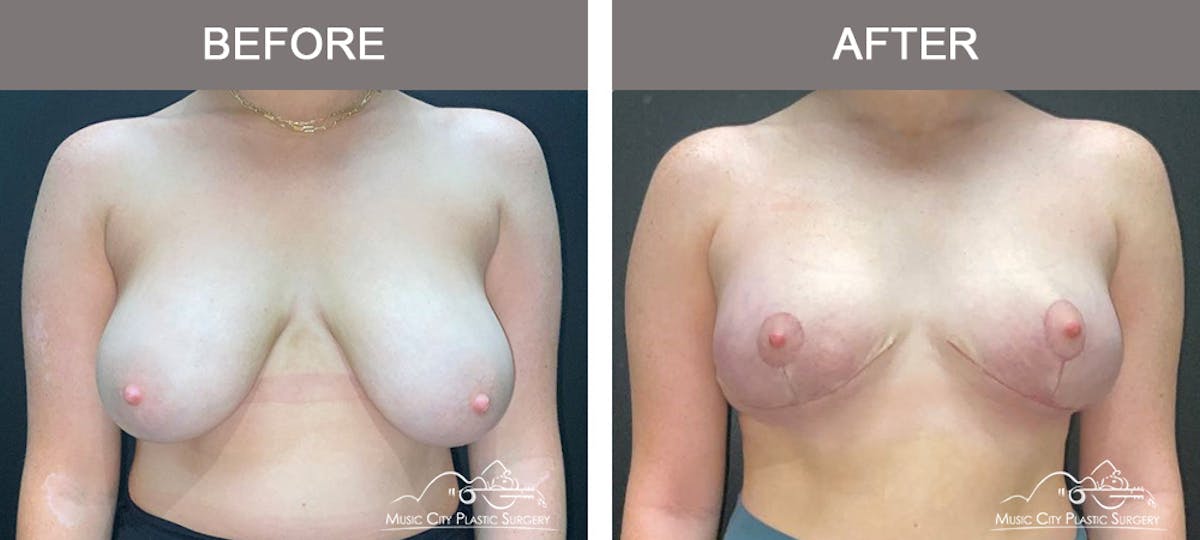 Breast Lift Before & After Gallery - Patient 365976 - Image 1