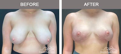 Breast Reduction Before & After Gallery - Patient 934857 - Image 1