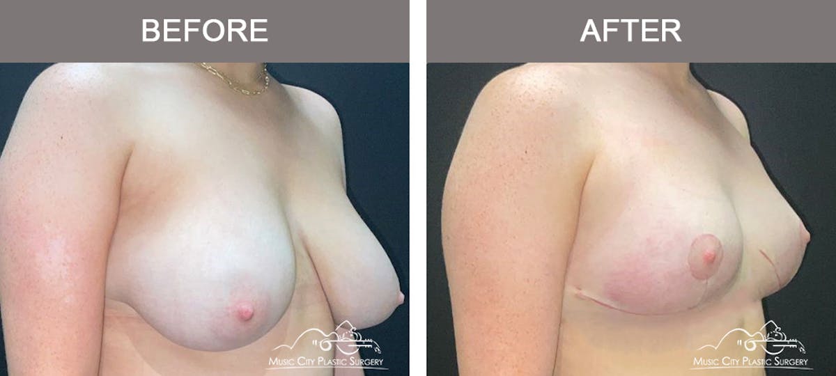 Breast Lift Before & After Gallery - Patient 365976 - Image 2