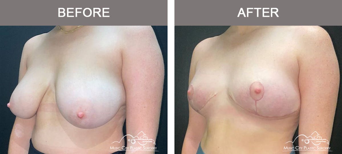 Breast Reduction Before & After Gallery - Patient 934857 - Image 4