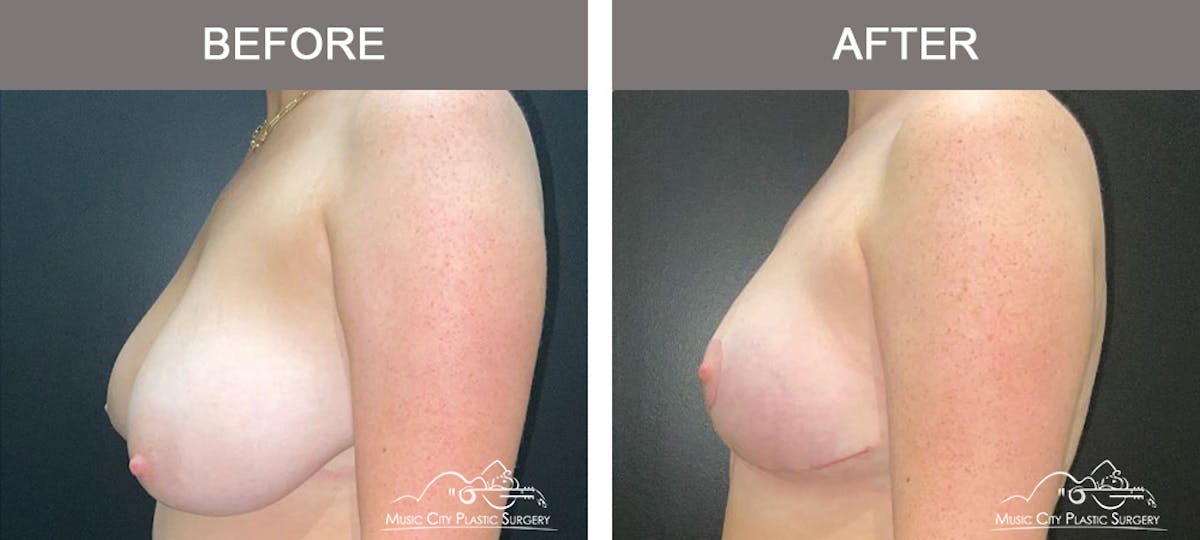 Breast Reduction Before & After Gallery - Patient 934857 - Image 5