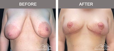 Breast Lift Before & After Gallery - Patient 421241 - Image 1