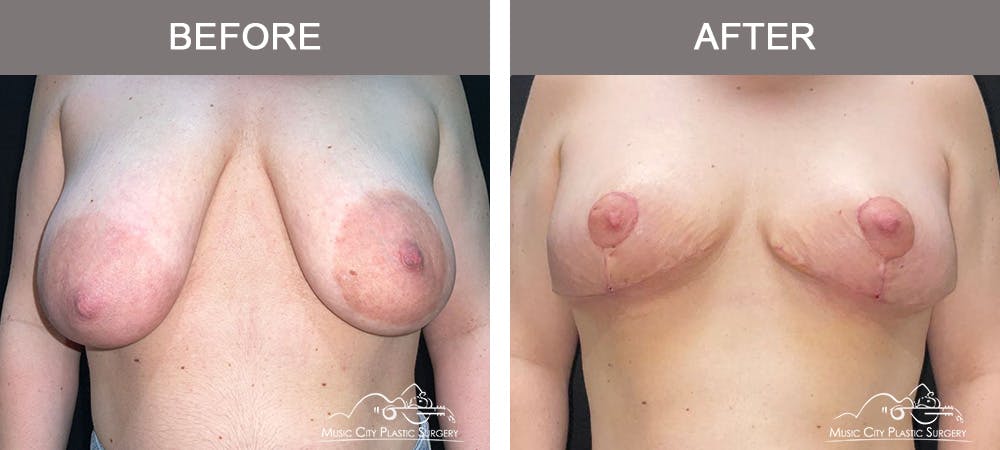 Breast Lift Before & After Gallery - Patient 421241 - Image 1