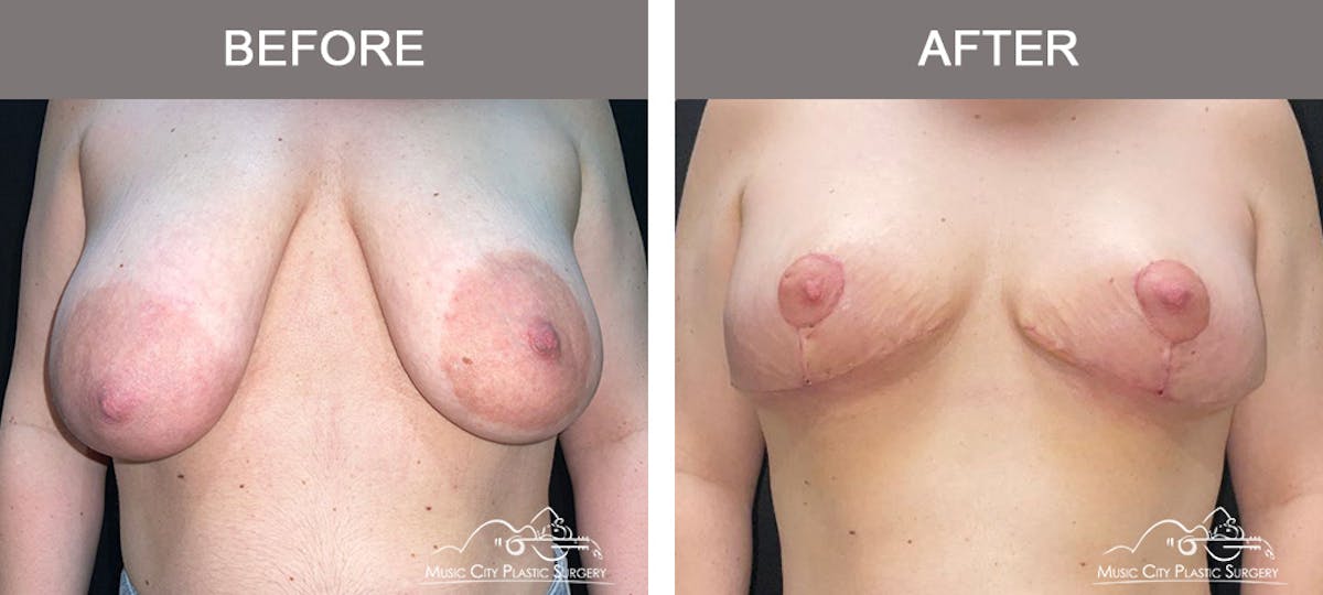 Breast Lift Before & After Gallery - Patient 421241 - Image 1