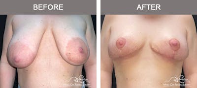 Breast Reduction Before & After Gallery - Patient 291989 - Image 1