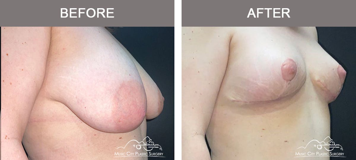 Breast Lift Before & After Gallery - Patient 421241 - Image 2