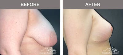 Breast Lift Before & After Gallery - Patient 421241 - Image 3