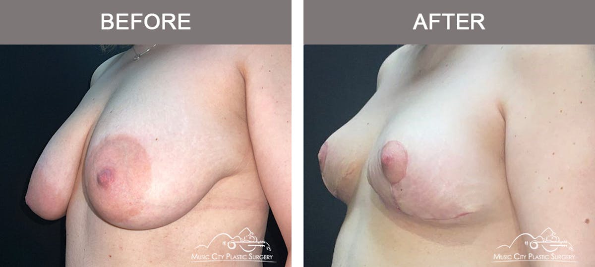 Breast Lift Before & After Gallery - Patient 421241 - Image 4